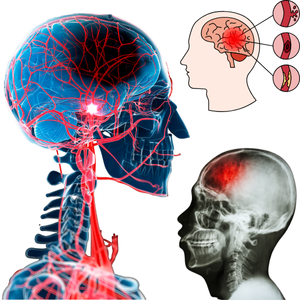 Derrame Cerebral